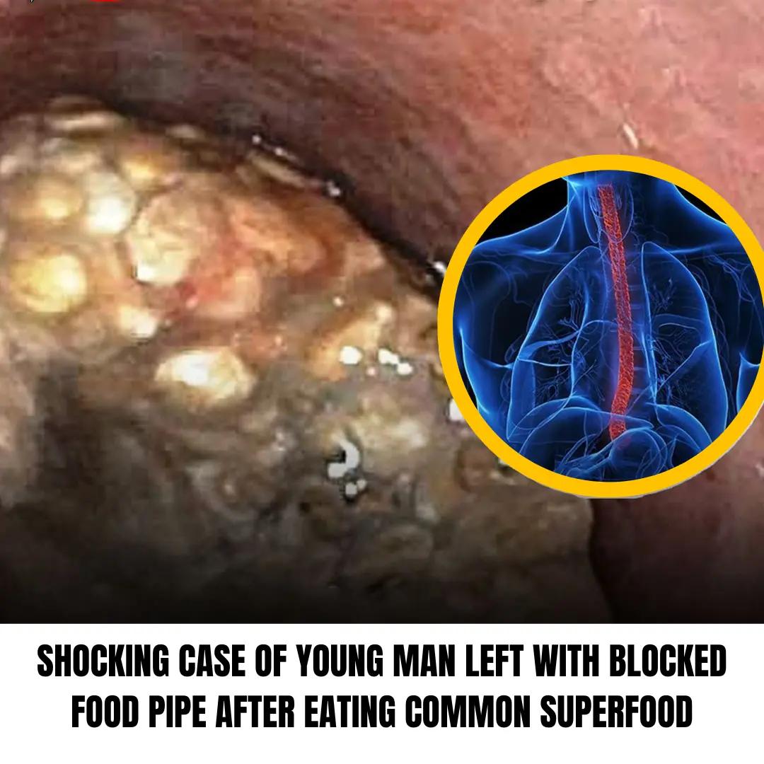 Routine Smoothie Ingredient Causes Severe Food Pipe Obstruction In Health-Conscious Teen