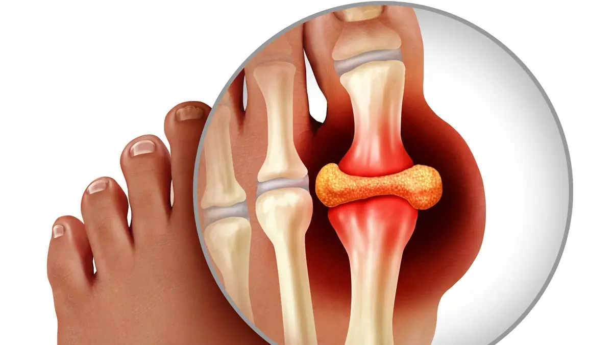 HIGH URIC ACID? SEE THE WARNING SIGNS & RELIEF TIPS