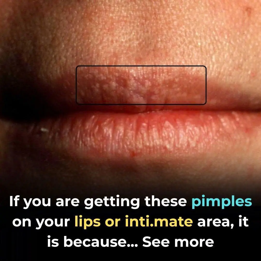 🧴 Pimples on Your Lips? What It Really Is & How to Treat It Safely