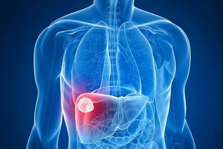 PANCREATIC CANCER NEEDS CATCHING EARLY. THE SIGNS AND SYMPTOMS TO LOOK OUT FOR