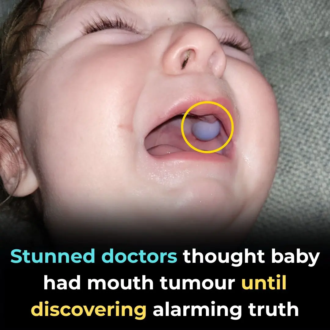 Doctors Feared Baby Had a Mouth Tumor—But the Real Cause Left Everyone Stunned