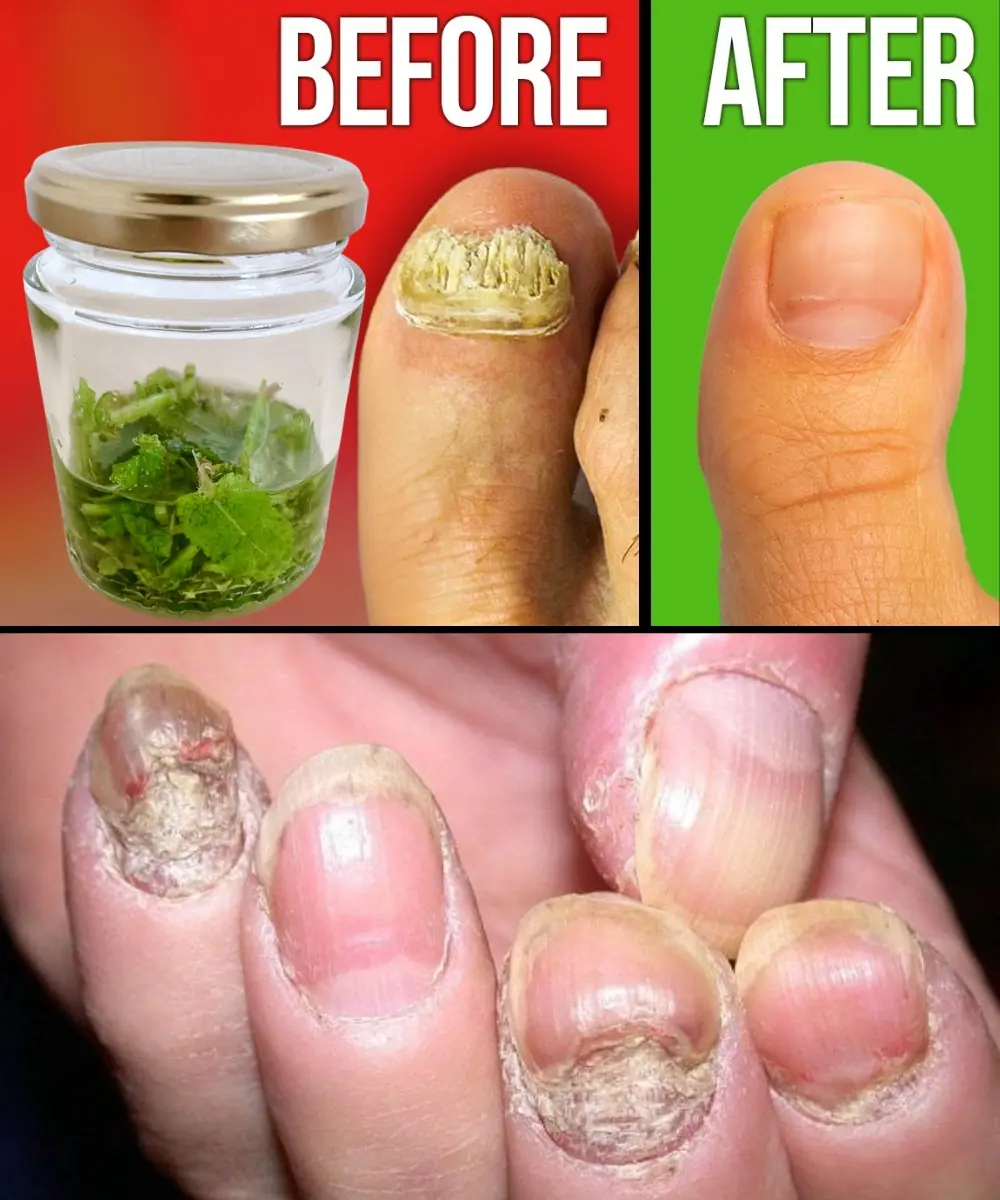 Discover the Secret of “Rompe Fungus”: Naturally Restore Healthy Nails!