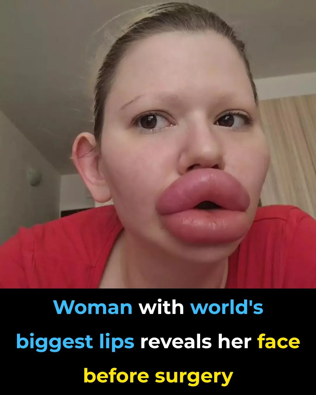 Before And After: Woman With Extreme Lip Enhancements Reveals Old Look