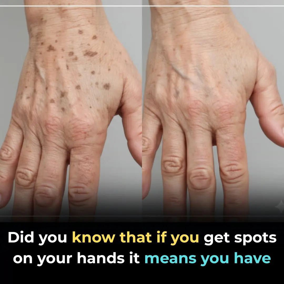 Did you know that if you get spots on your hands it means you have