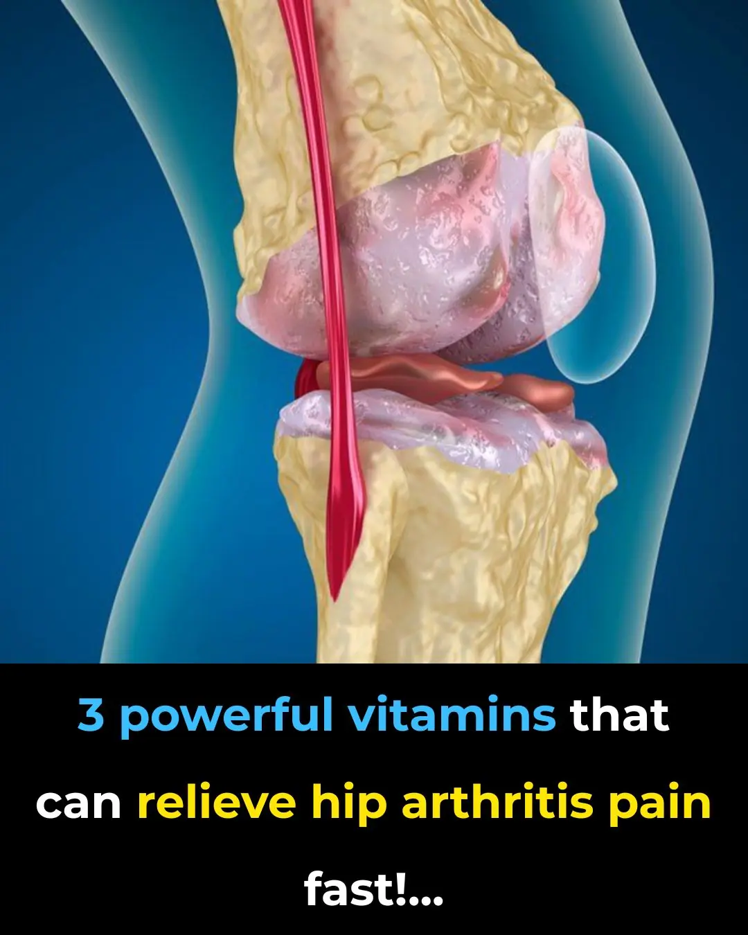 Top 3 Vitamins for Hip Arthritis – Say Goodbye to Hip Pain