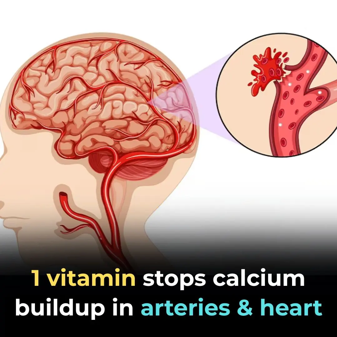 1 Vitamin Stops Calcium Buildup in Arteries and Heart