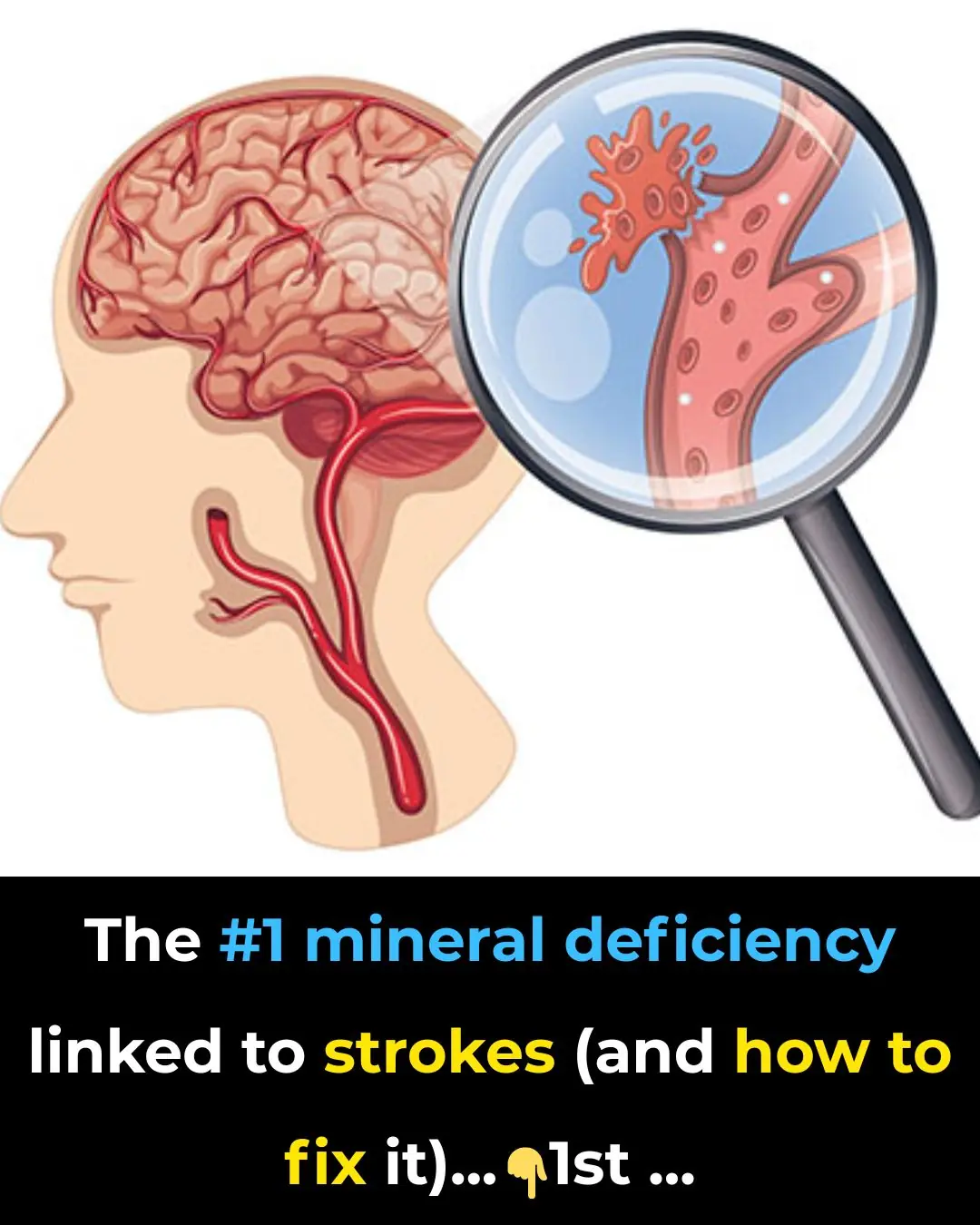 The #1 mineral deficiency linked to strokes (and how to fix it)