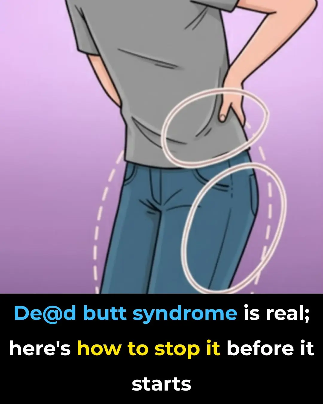 Dead Butt Syndrome Is Real