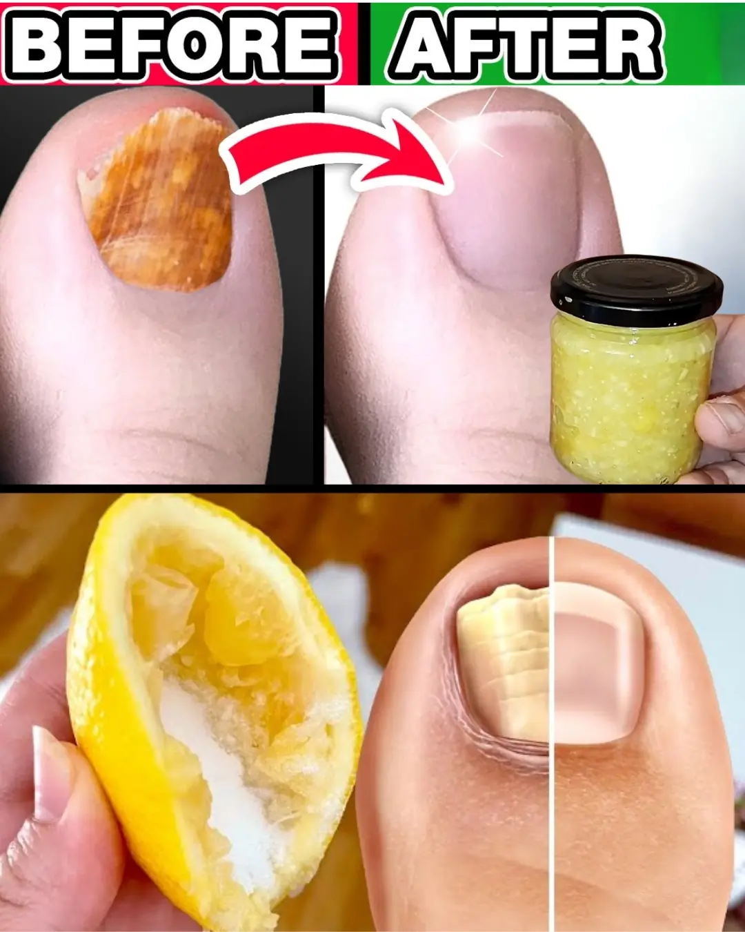 #1 Absolute Best Toenail Fungus Cure You Can Make at Home with Just 3 Ingredients