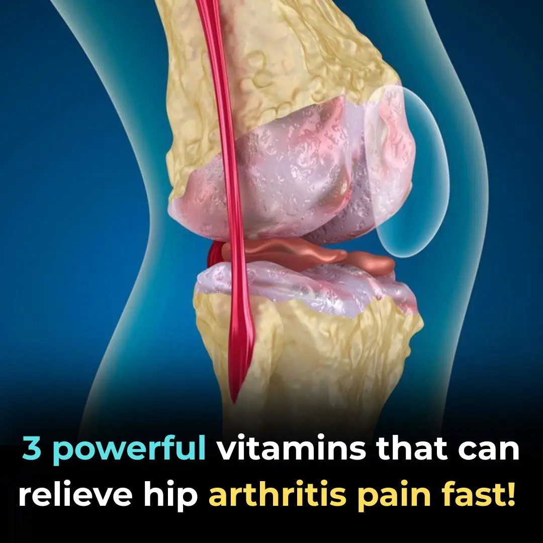 Top 3 Vitamins for Hip Arthritis