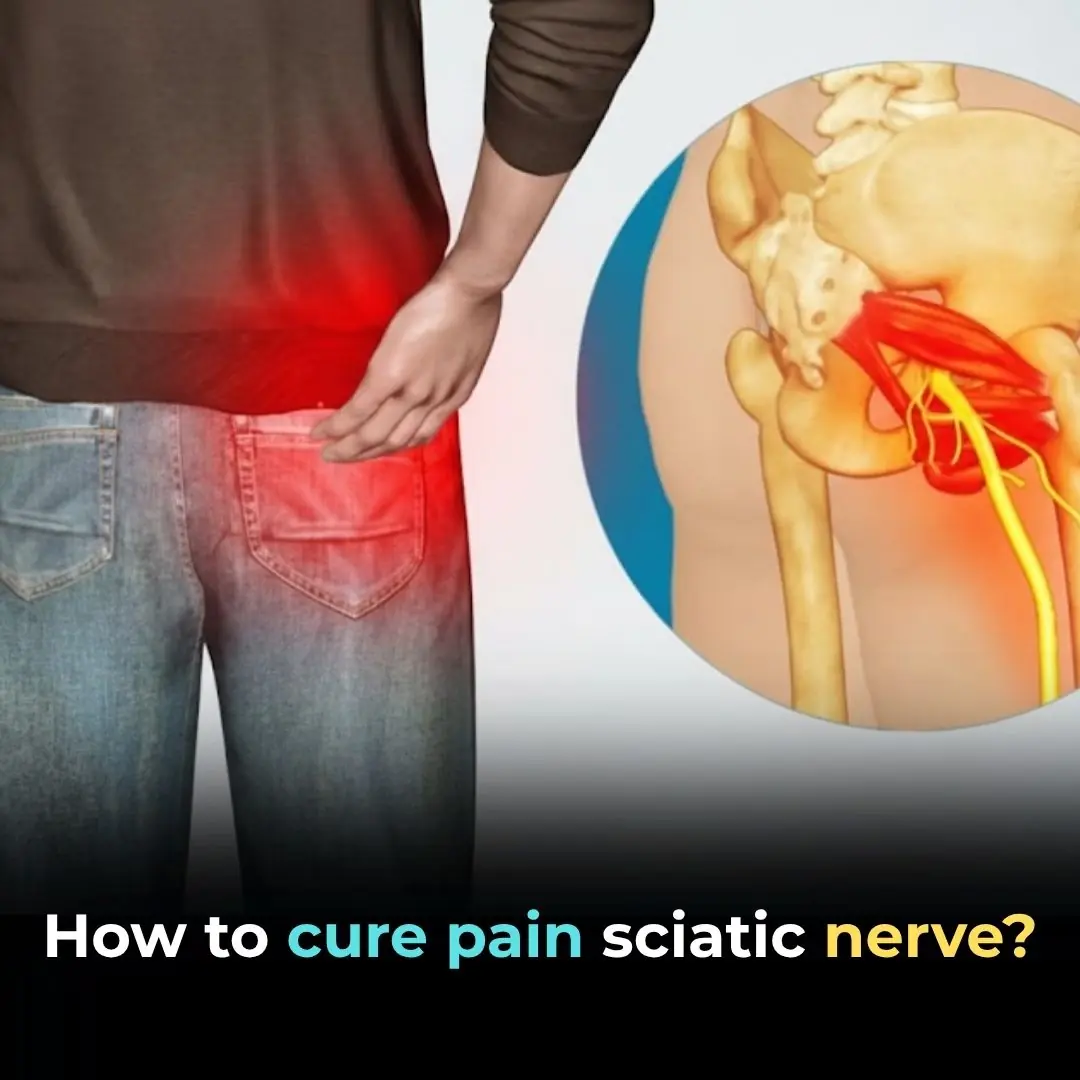 How to Cure Sciatic Nerve Pain: A Guide to Natural Remedies