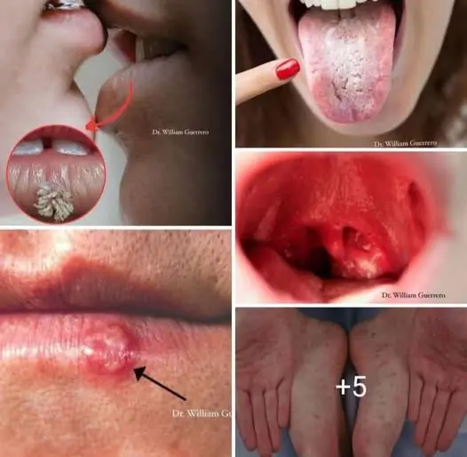 Mouth Cancer: Symptoms, Causes, Stages, and Treatment