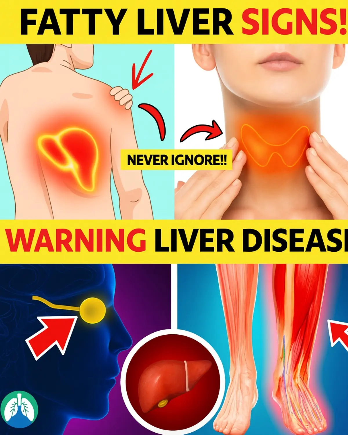 Never Ignore These 8 Early Signs of a Fatty Liver