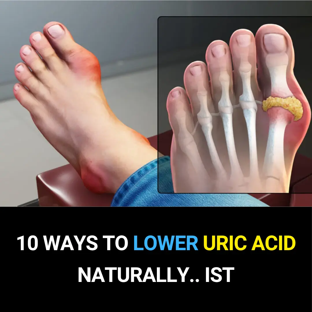 10 Proven Ways to Lower Uric Acid Naturally (Backed by Science)