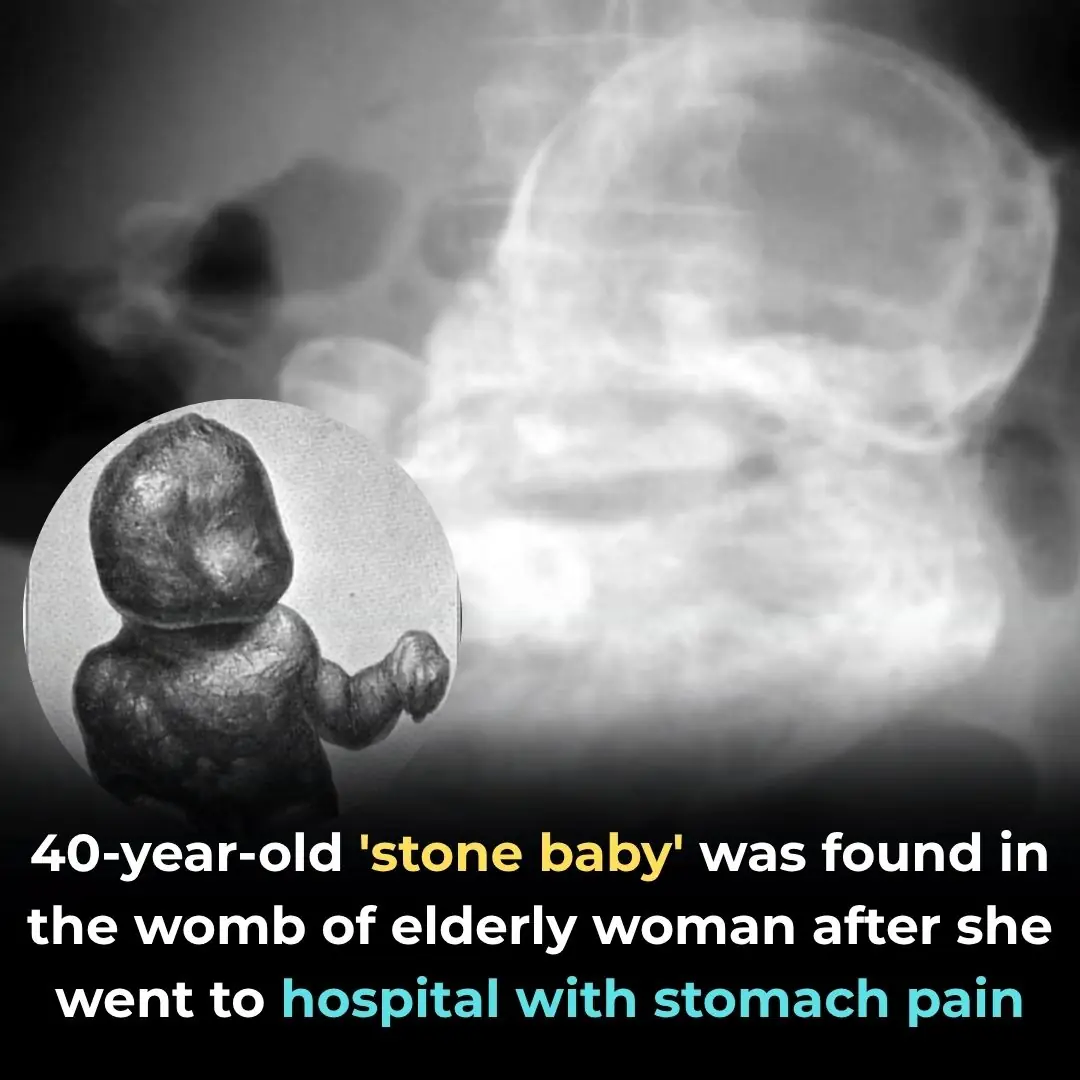 40-Year-Old ‘Stone Baby’ Discovered in Elderly Woman’s Womb After Hospital Visit for Stomach Pain