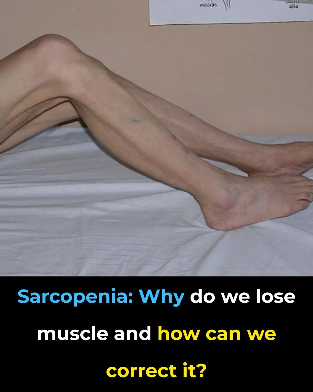 Sarcopenia: Causes of Muscle Loss and How to Regain Strength