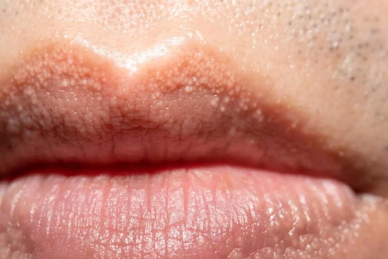 White Bumps or Spots on Lips: Causes and Effective Treatments