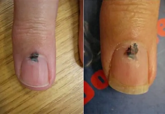 6 Body Parts That Turn Black May Signal Cancer — Don’t Ignore Them