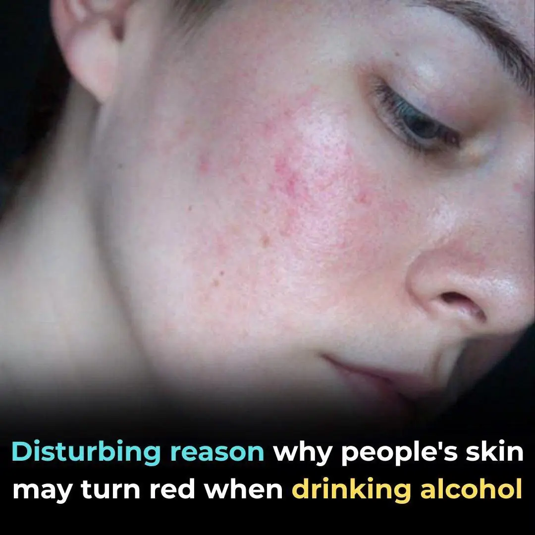 Why Some People’s Skin Turns Red When Drinking Alcohol