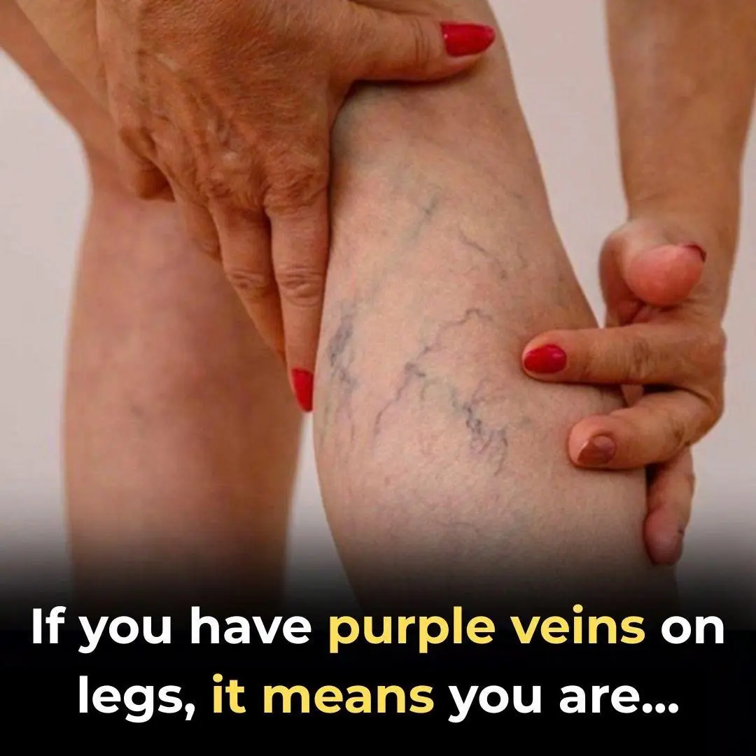 Purple Veins on Your Legs