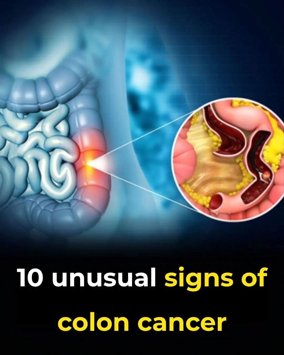 10 Warning Signs of Bowel (Colorectal) Cancer You Shouldn’t Ignore