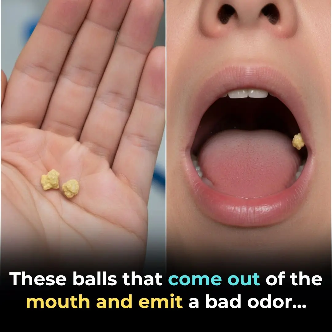 🌿 Natural Ways to Fight Bad Breath & Tonsil Stones — Safely and Effectively