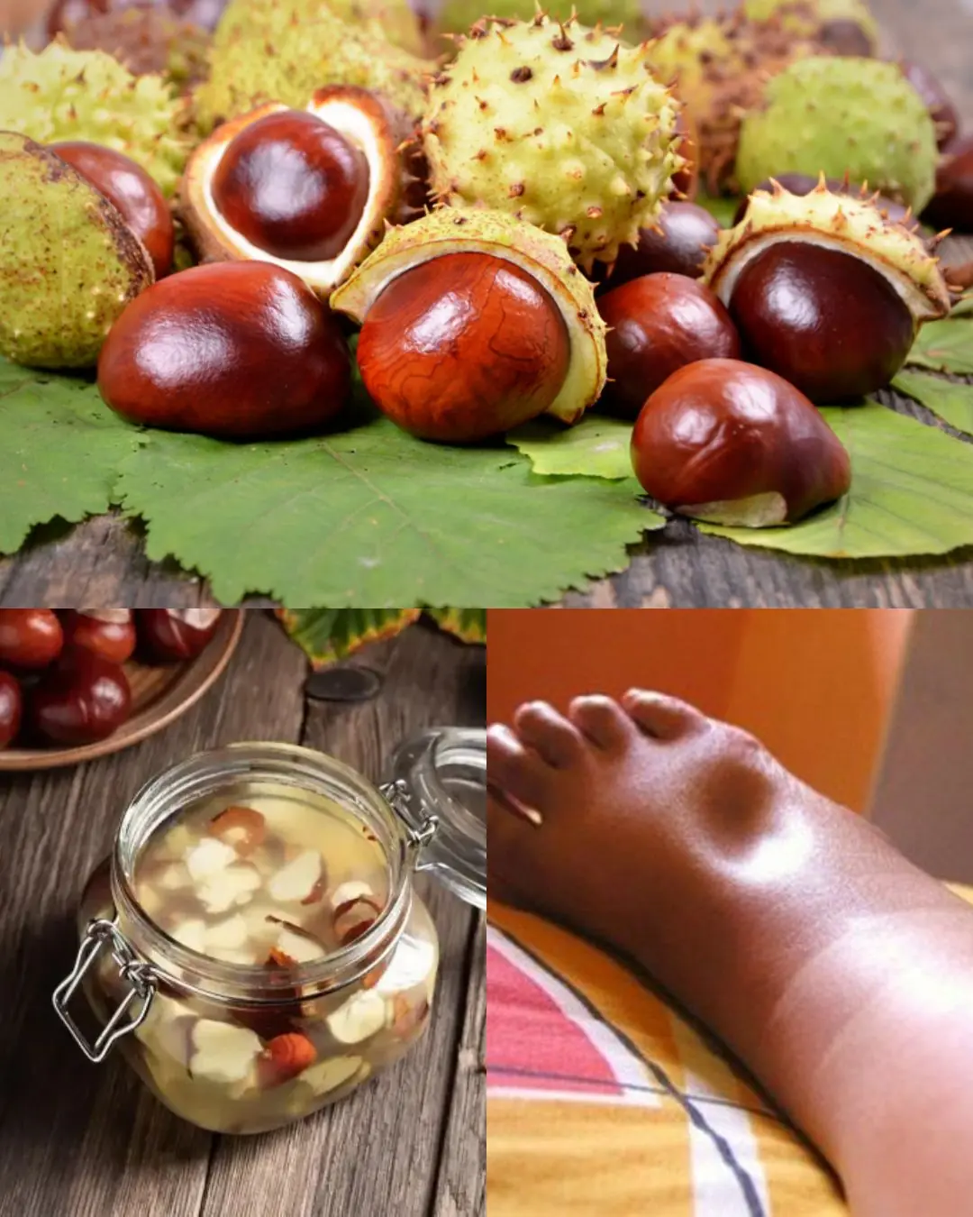 Horse Chestnut: The Strongest Natural Remedy for Swollen Legs and More…