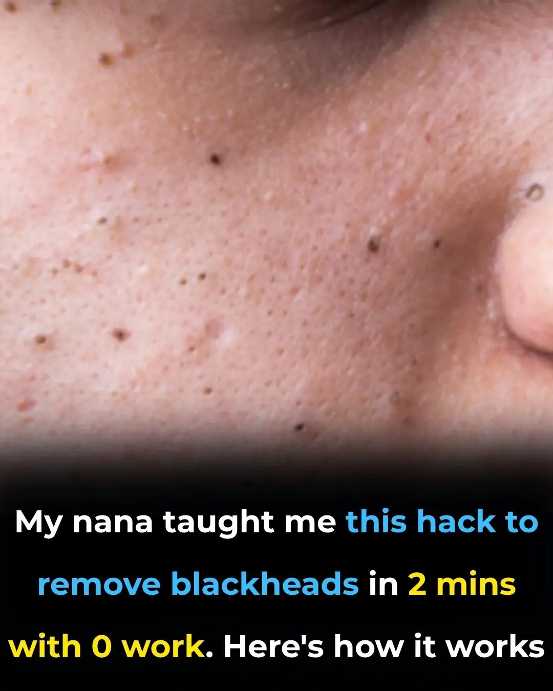 My nana taught me this hack to remove blackheads in 2 mins with 0 work. Here’s how it works