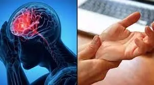 3 Warning Signs That Appear Days Before a Stroke Everyone Should Know to Prevent It