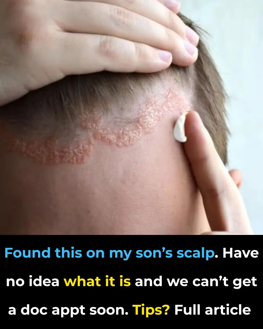 Found this on my son’s scalp. Have no idea what it is and we can’t get a doc appt soon. Tips?