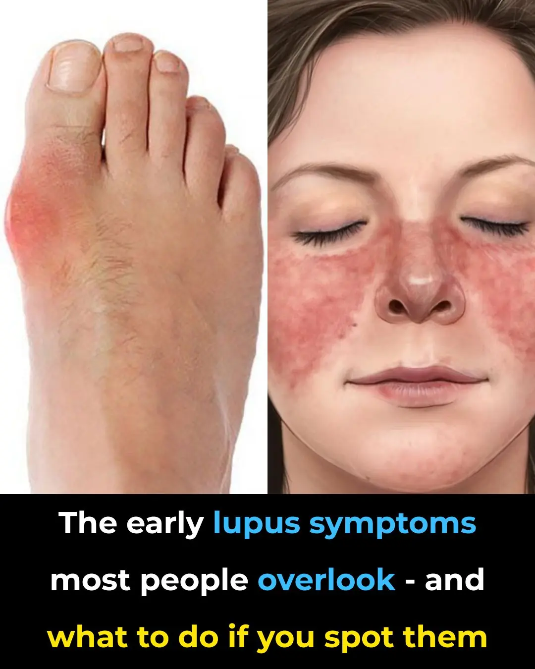 13 Early Warning Signs of Lupus You Need to Know (And What To Do The Moment You See Them)