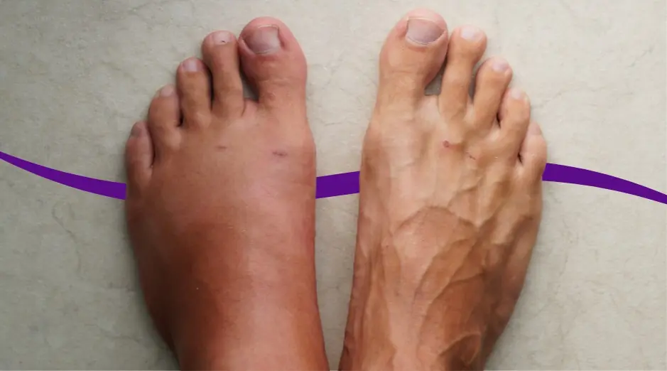 THE NATURAL FIX THAT FINALLY GOT RID OF MY SWOLLEN FEET