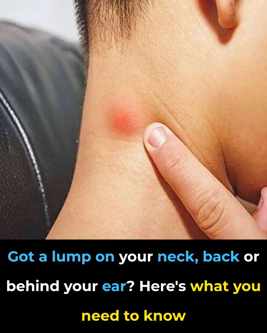 Got a lump on your neck, back or behind your ear? Here’s what you need to know