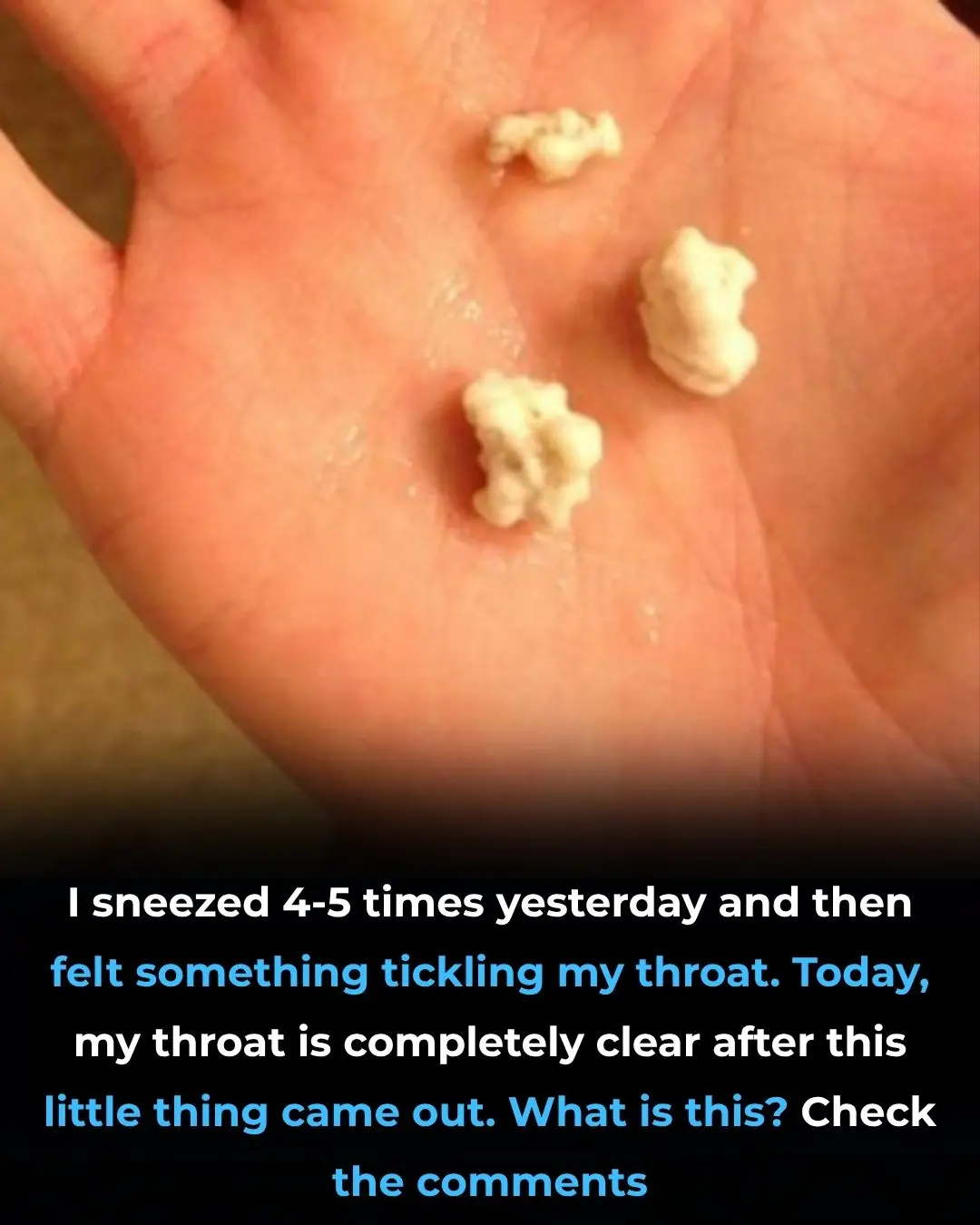 Here’s what you need to know about tonsil stones – the weird pimple-like growths in your throat