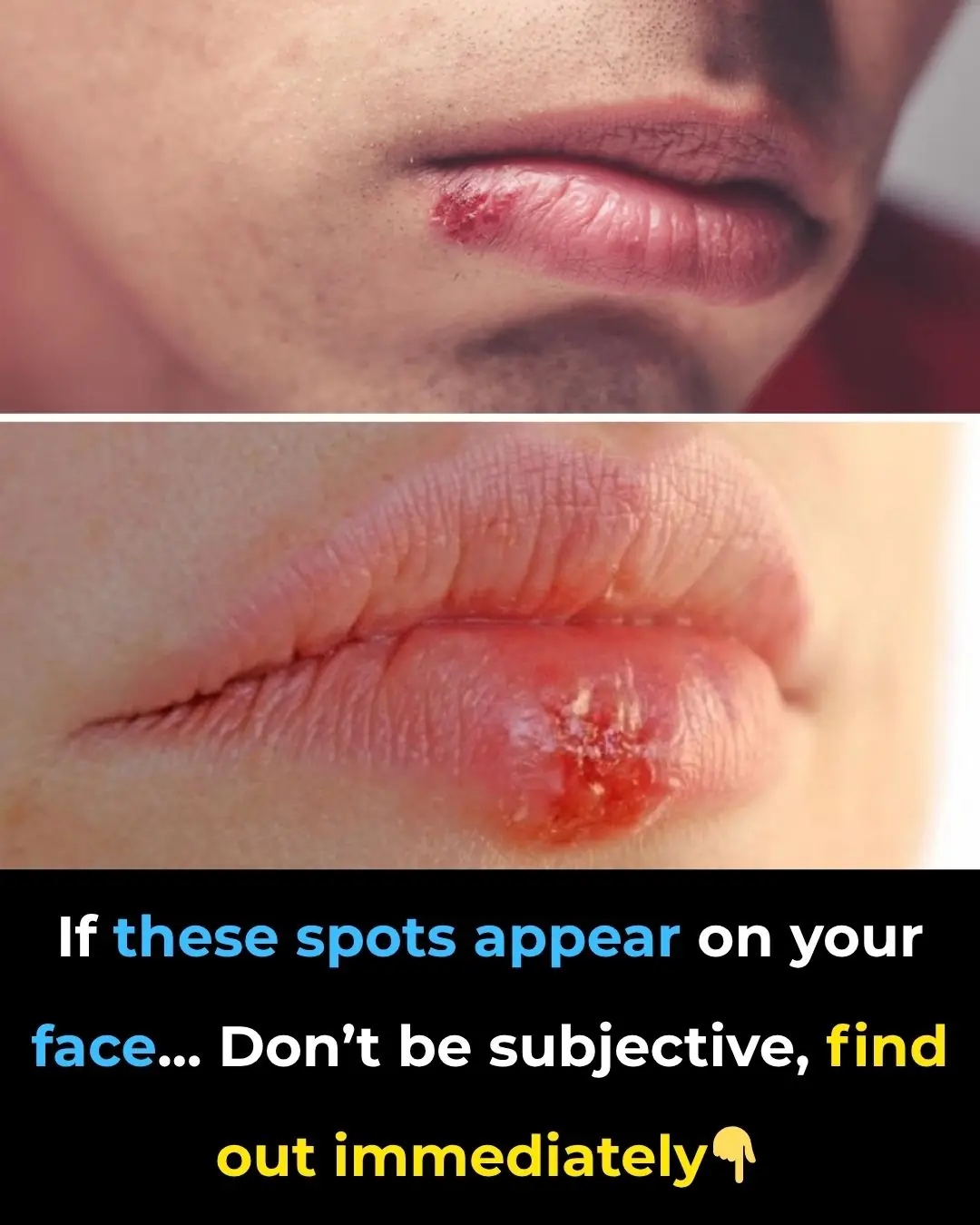 Most People Carry This Cold Sore Virus—But Few Know How to Control It