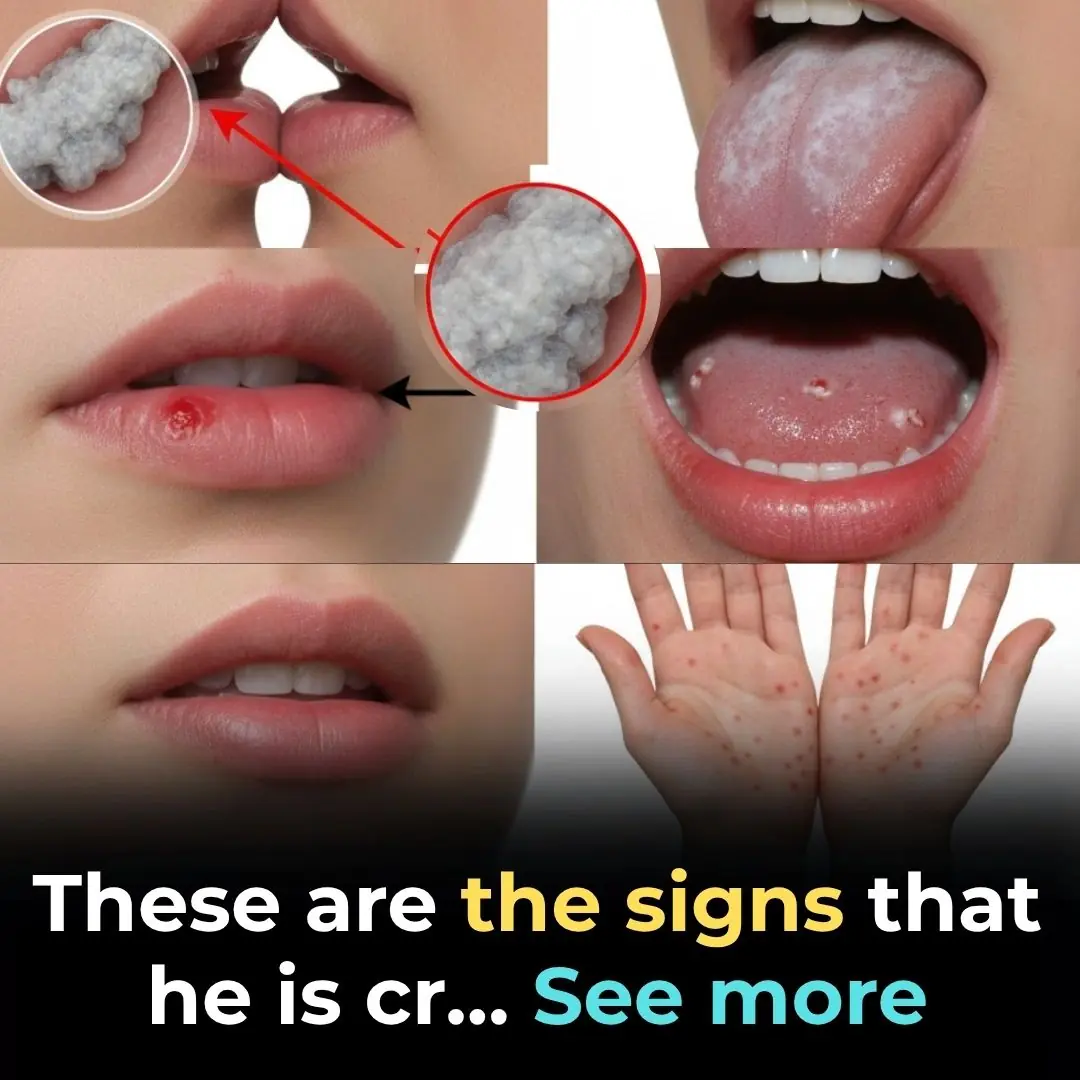 🦷 Mouth Cancer: Symptoms, Causes, Stages, and Treatment – What You Need to Know