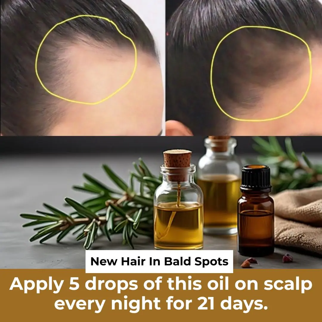 Clove Rosemary Bayleaf Oil : Get New Hair In Bald Spots