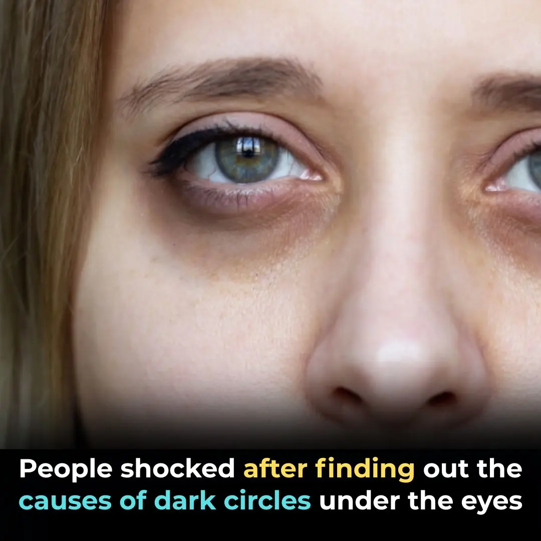 Why You Might Have Dark Circles …Even If You’re Sleeping Well