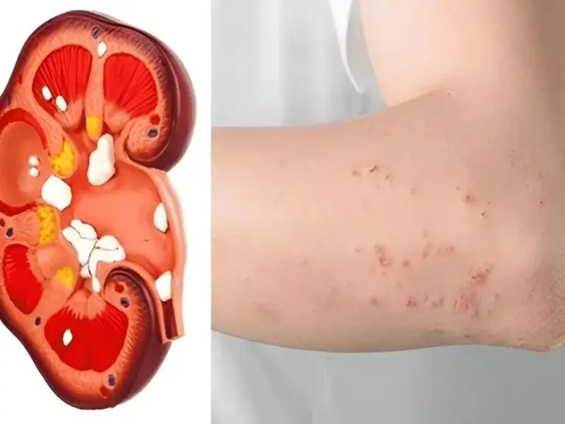 8 Early Signs of Mild Kidney Dysfunction Many People Overlook Until It Becomes Serious