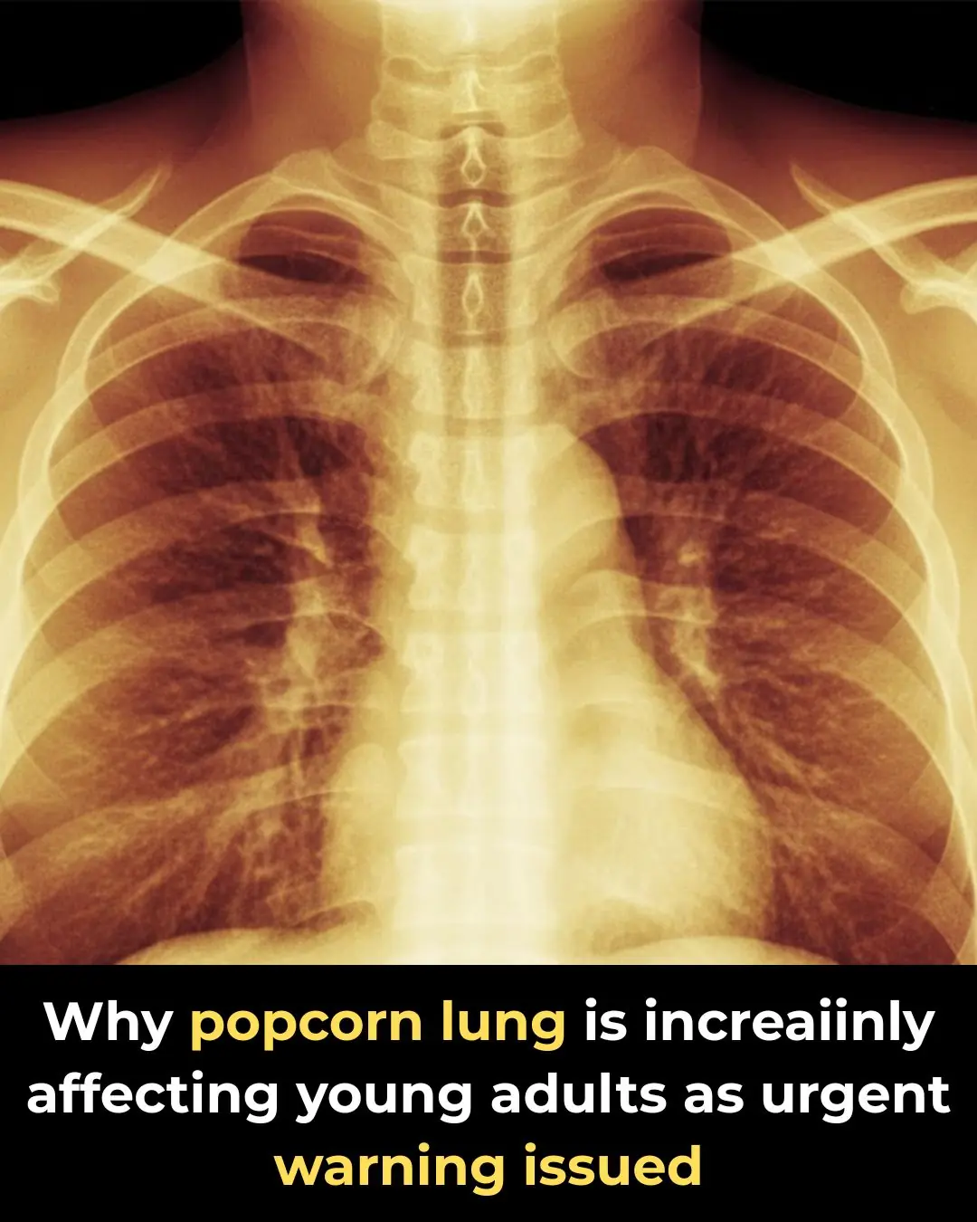 Doctors Warn Of Rising Cases Of “Popcorn Lung” Among Young Adults — Here’s What You Need To Know
