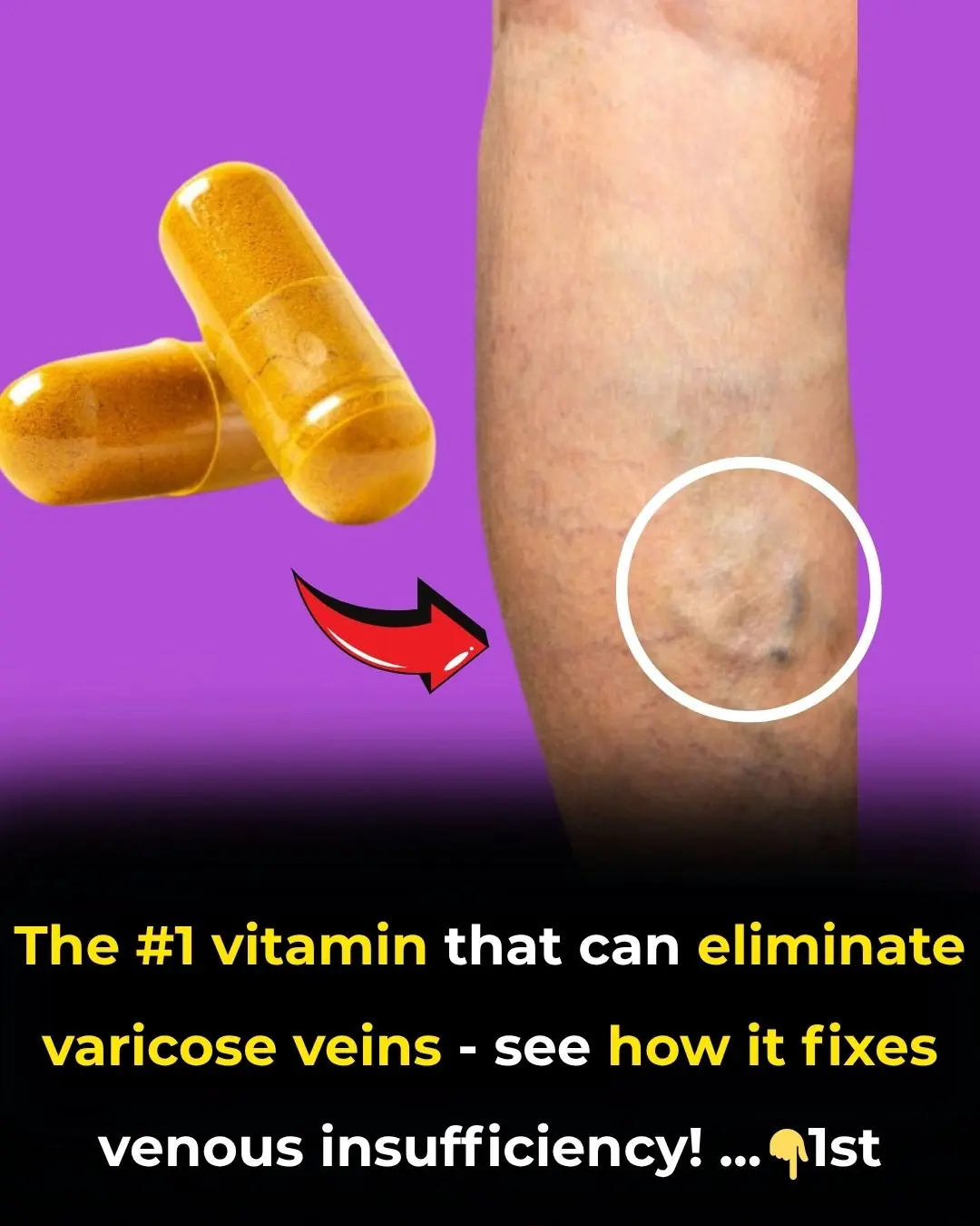 The #1 vitamin that can eliminate varicose veins—see how it fixes venous insufficiency!
