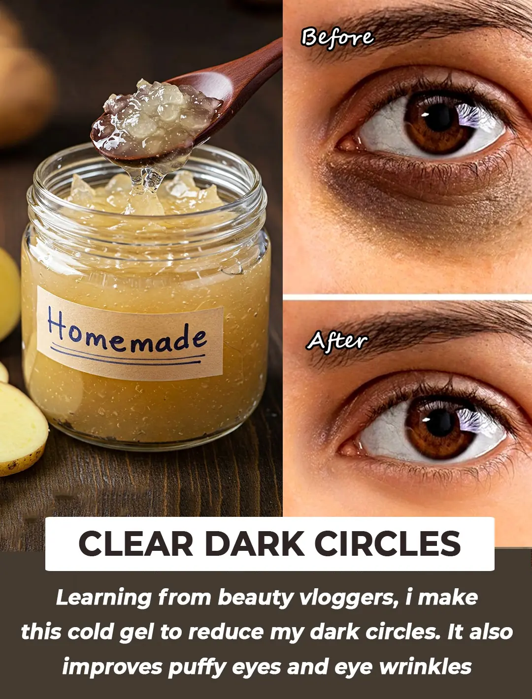 Treat Dark Circles, Sunken Eyes & Puffy Eyes with Home Remedies and Eye Creams