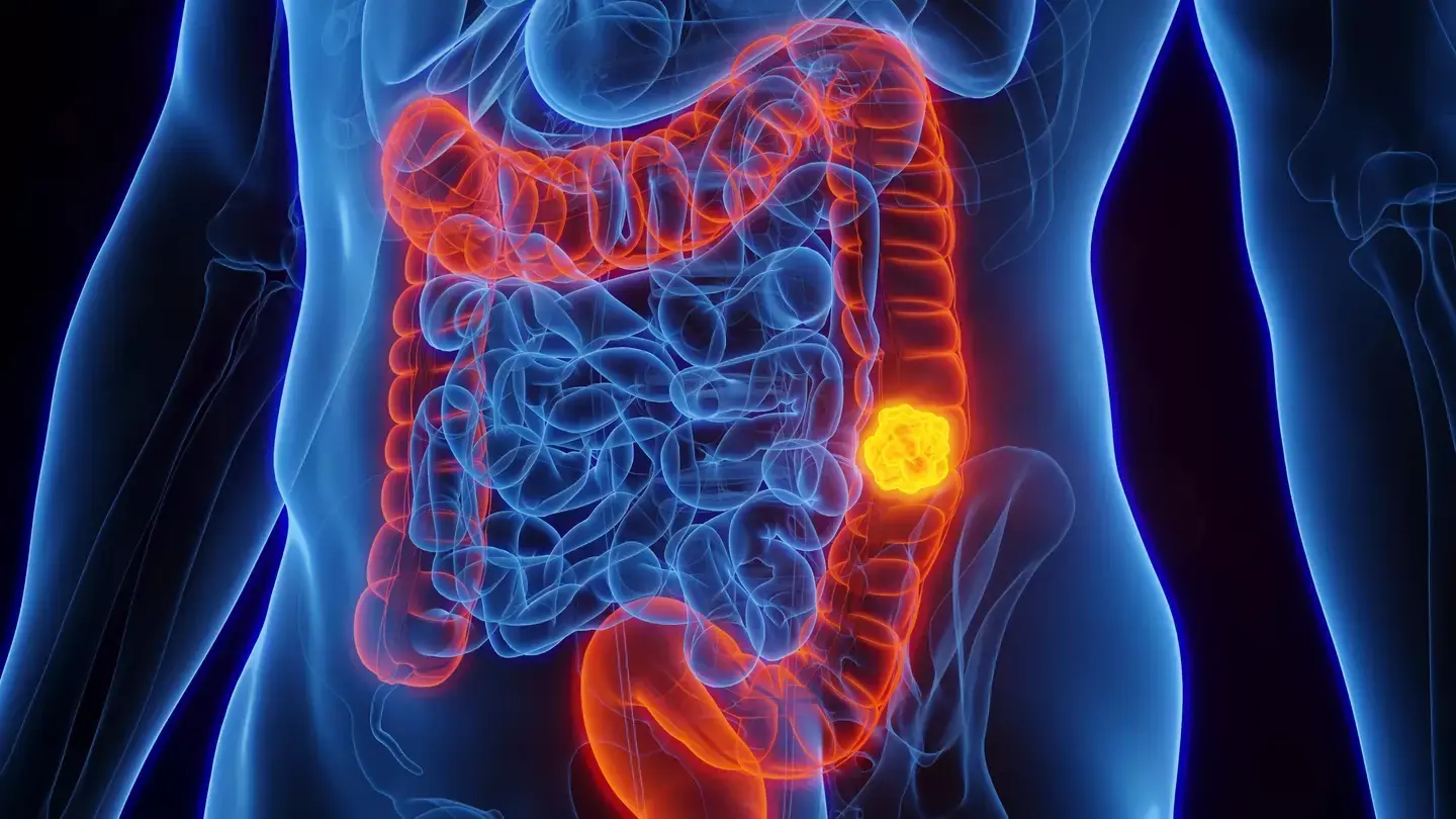 Woman reveals 5 colon cancer symptoms that shouldn’t be ignored