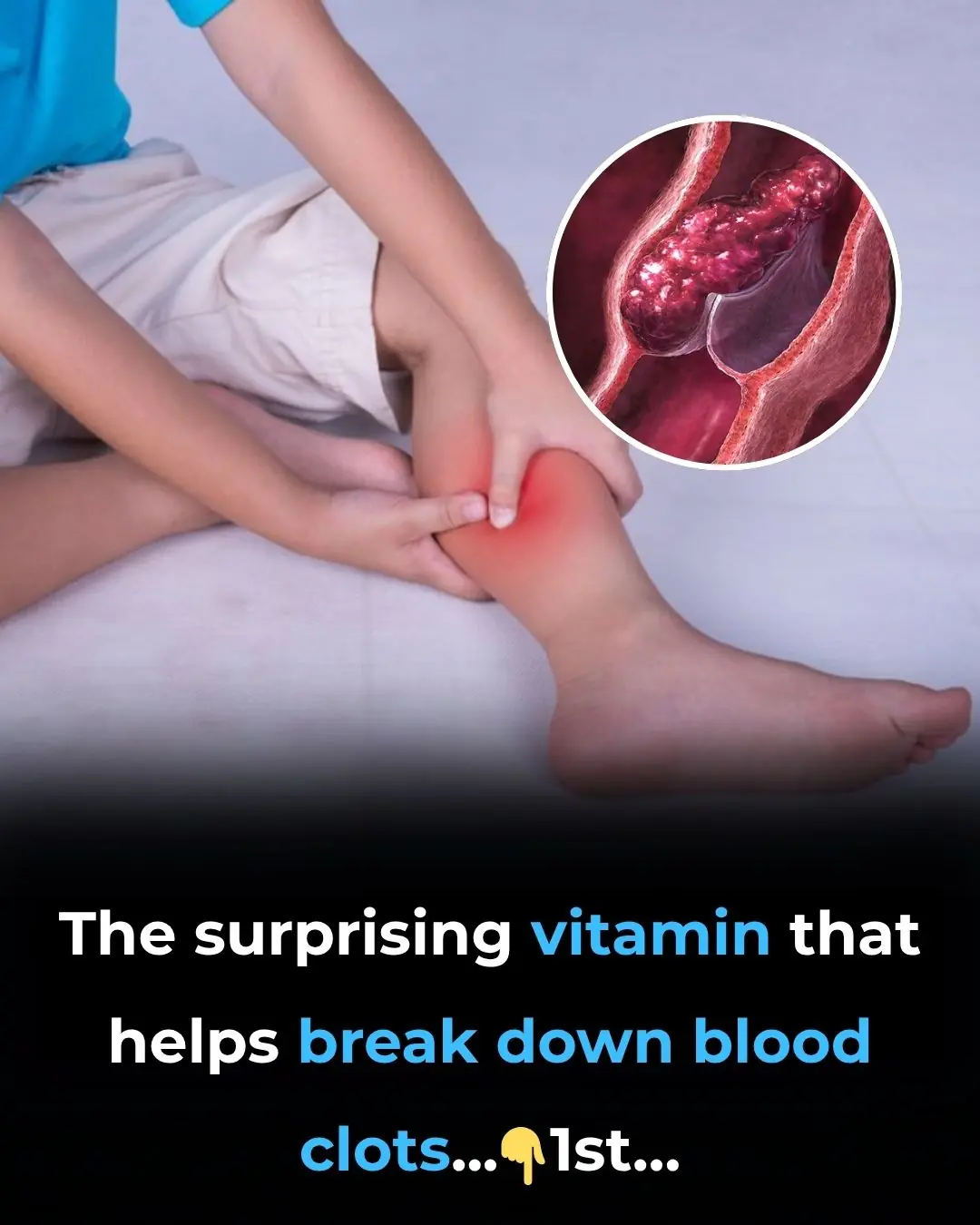 The surprising vitamin that helps break down leg clots—are you getting enough?