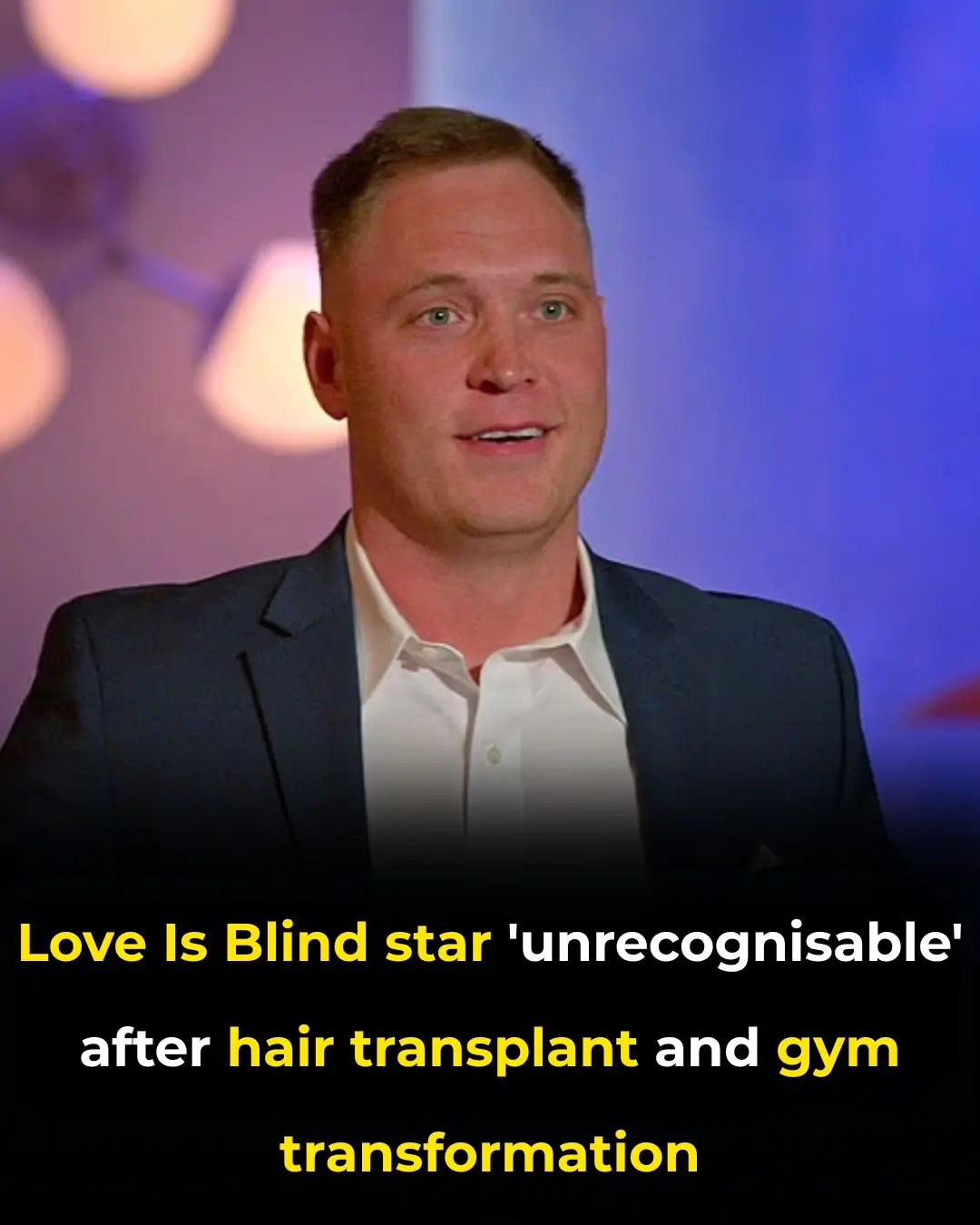 🤯 Love Is Blind’s Jimmy Presnell Becomes 'Unrecognisable' After $14.5K Hair Transplant and Full Body 'Glow Up'
