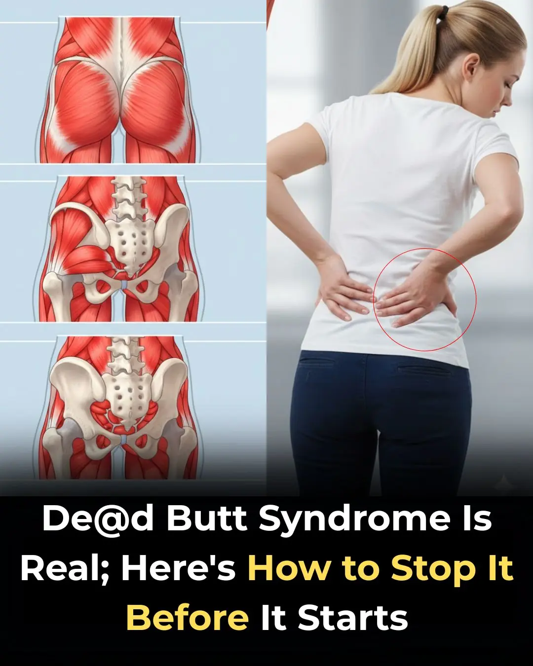 Dead Butt Syndrome Is Real
