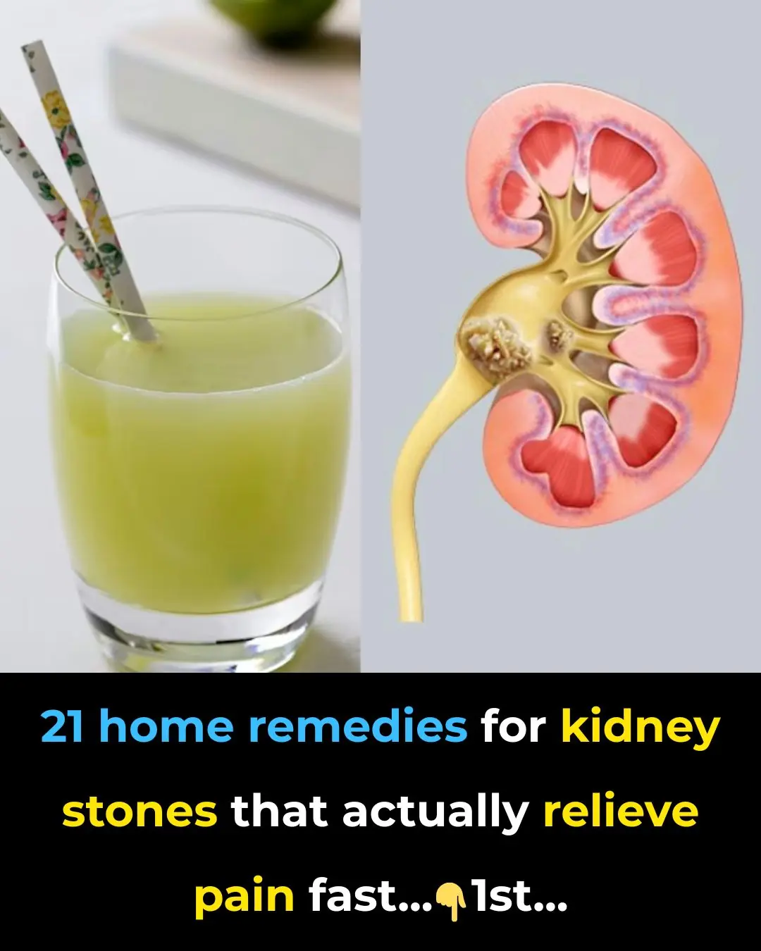 Home Remedies For Kidney Stones – 21 Remedies For Effective Pain Relief