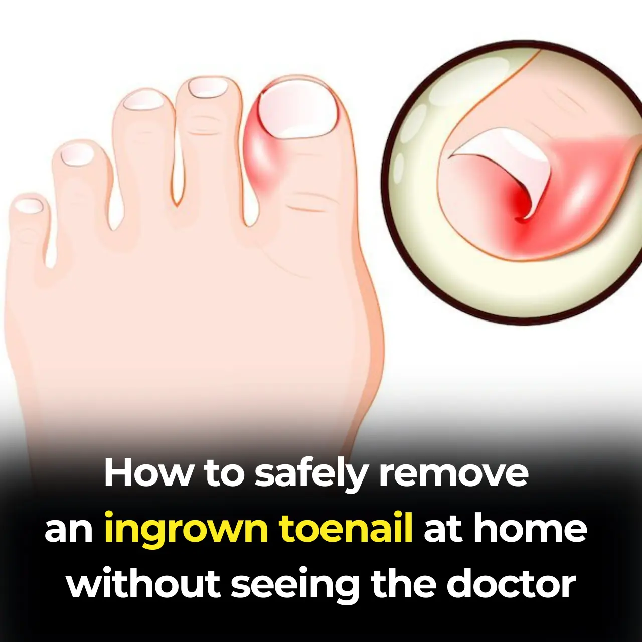How to Effectively Remove a Painful Ingrown Toenail WITHOUT Having To Go To The Doctor