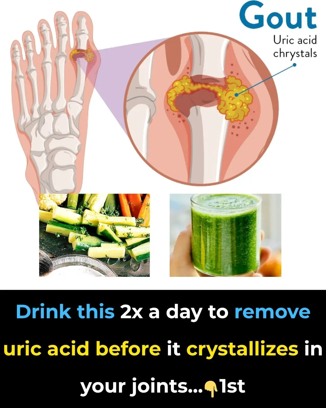 Drink This 2X a Day to Remove Uric Acid Before it Crystallizes in Your Joints and Becomes Painful