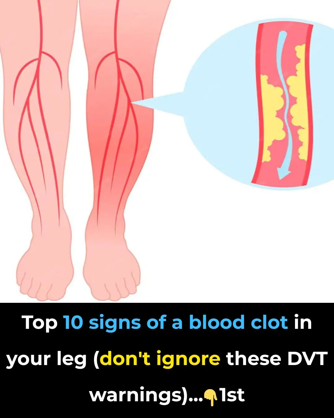 Top 10 signs of a BLOOD CLOT in your leg (prevent Deep Vein Thrombosis)